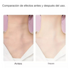 Stretch ™ - Equipo Rejuvenecedor Facial Y De Cuello